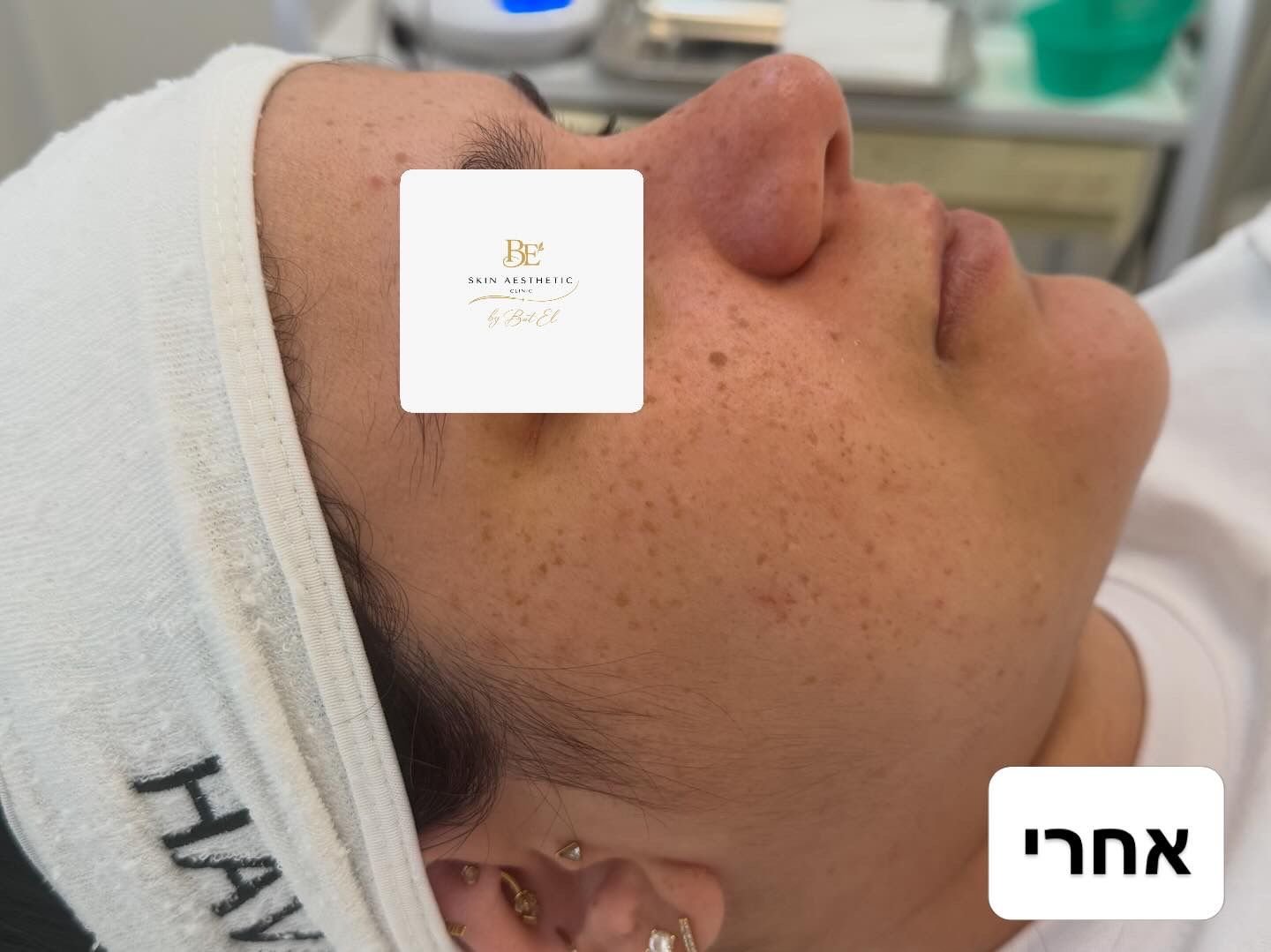 אחרי טיפול באקנה